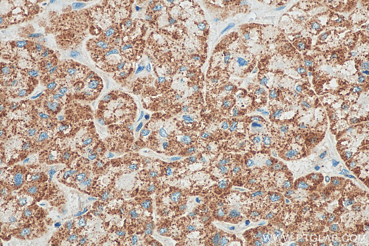 Immunohistochemistry (IHC) staining of human liver cancer tissue using GSTK1 Polyclonal antibody (14535-1-AP)