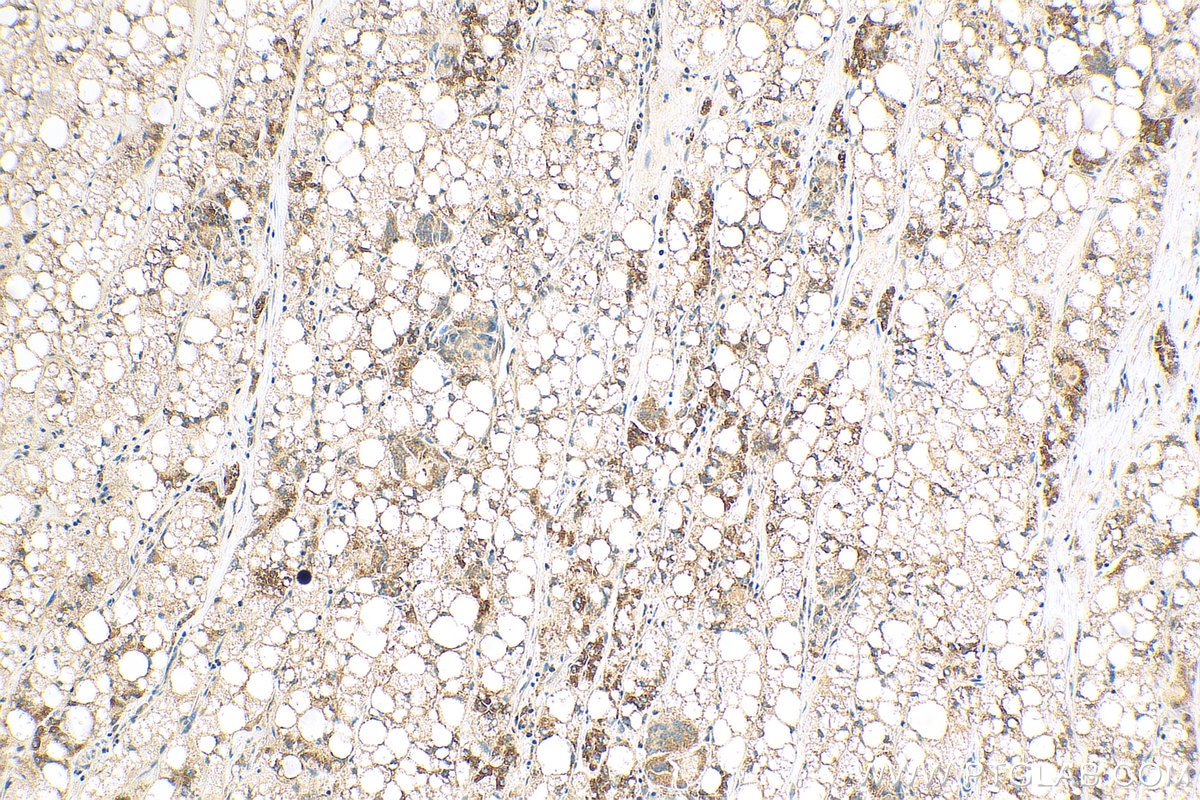 Immunohistochemistry (IHC) staining of human liver cancer tissue using GSTK1 Recombinant antibody (81527-1-RR)