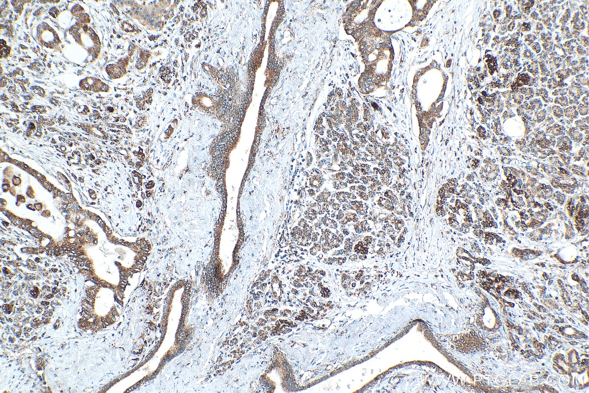 Immunohistochemistry (IHC) staining of human pancreas cancer tissue using GSTK1 Recombinant antibody (81527-1-RR)