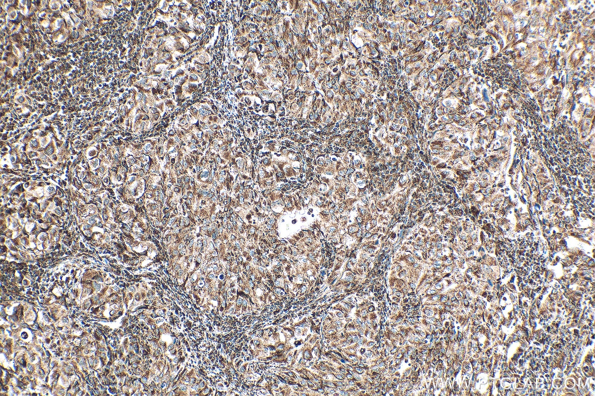 IHC staining of human lung cancer using 81527-1-RR