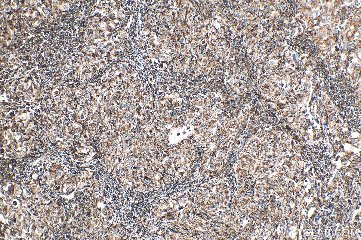 Immunohistochemistry (IHC) staining of human lung cancer tissue using GSTK1 Recombinant antibody (81527-1-RR)