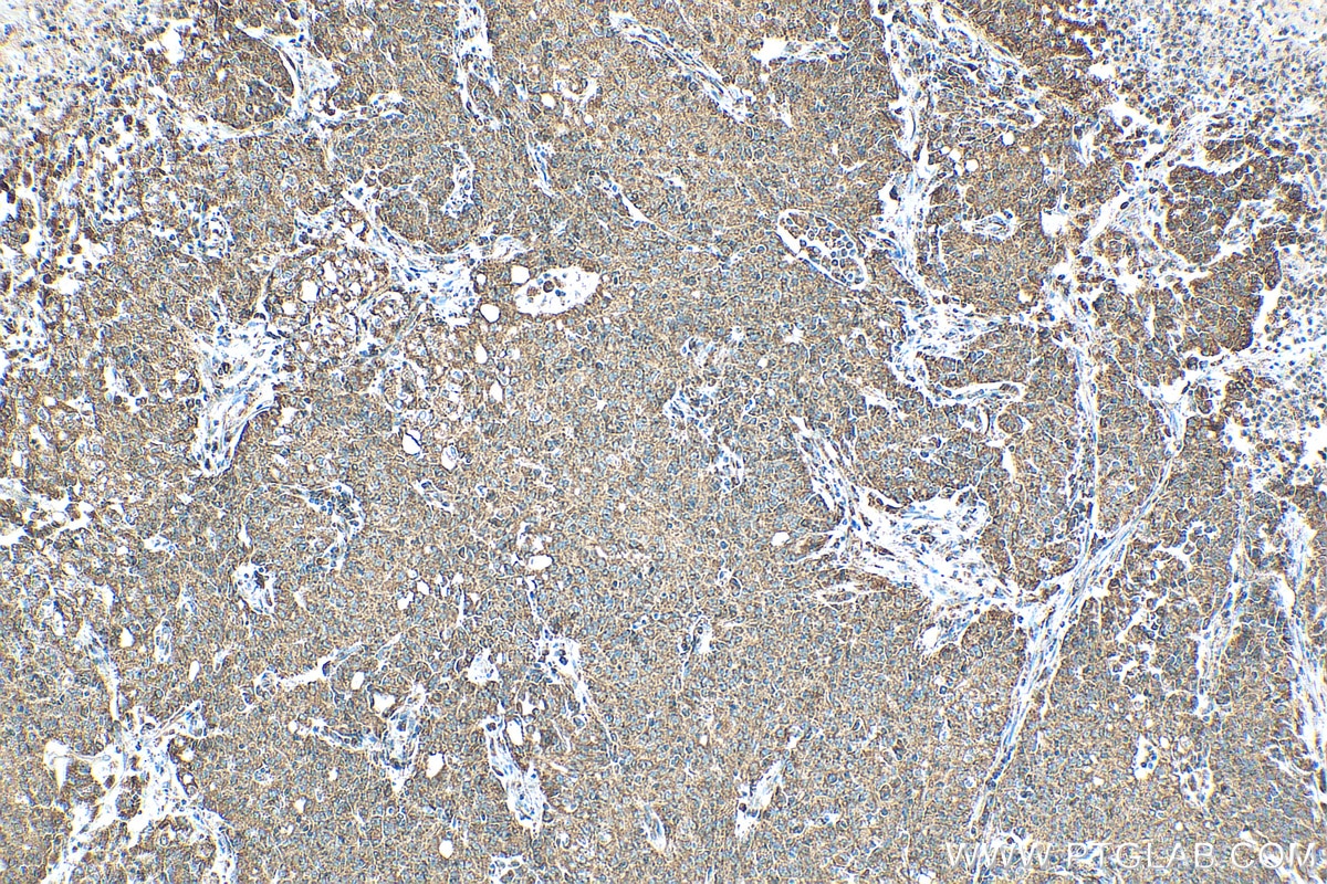 Immunohistochemistry (IHC) staining of human stomach cancer tissue using GSTK1 Recombinant antibody (81527-1-RR)