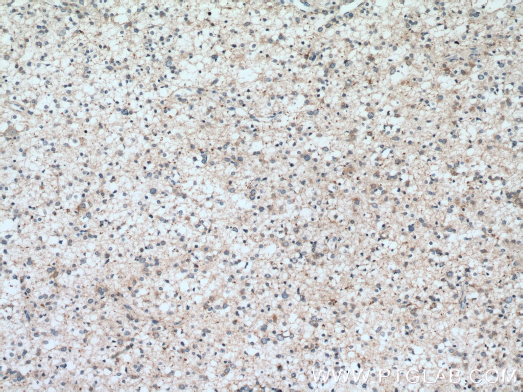 Immunohistochemistry (IHC) staining of human gliomas tissue using GSTM1 Polyclonal antibody (12412-1-AP)