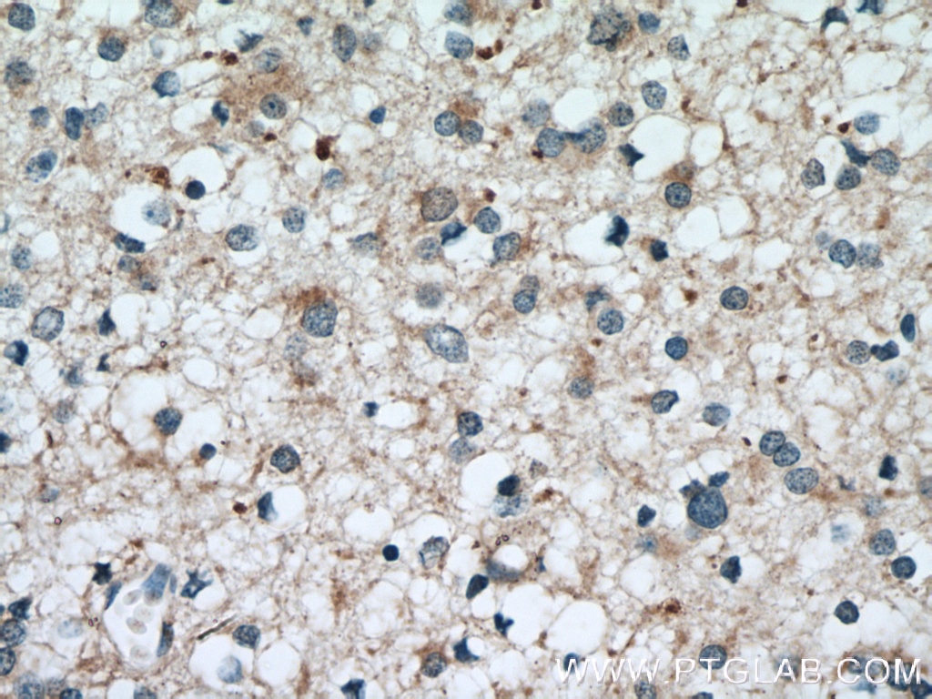 Immunohistochemistry (IHC) staining of human gliomas tissue using GSTM1 Polyclonal antibody (12412-1-AP)