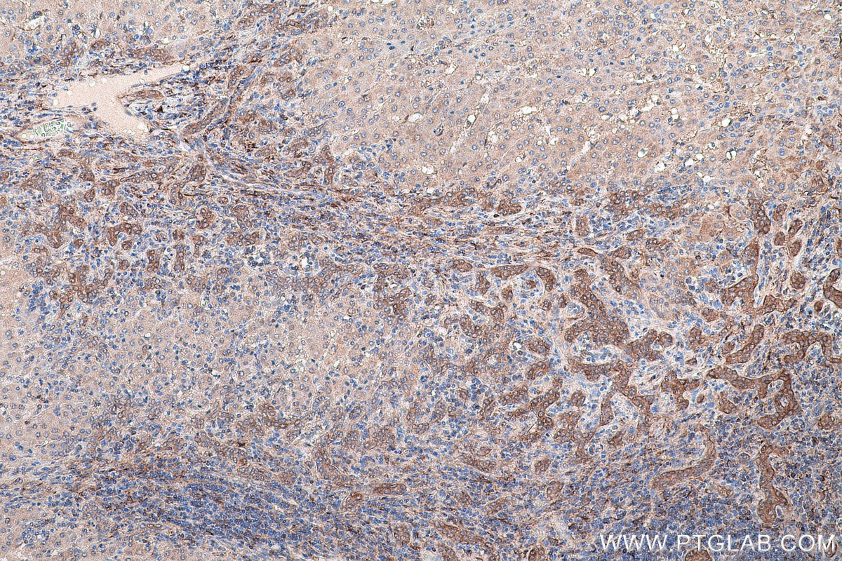 Immunohistochemistry (IHC) staining of human liver cancer tissue using GSTM3 Monoclonal antibody (67634-1-Ig)