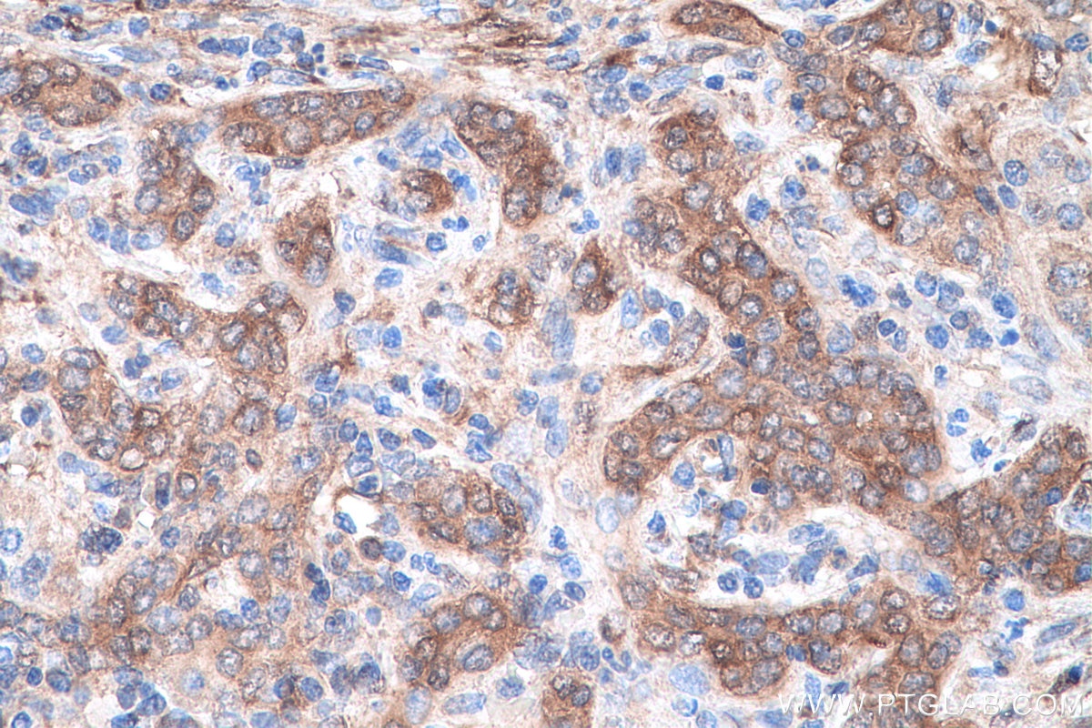 Immunohistochemistry (IHC) staining of human liver cancer tissue using GSTM3 Monoclonal antibody (67634-1-Ig)