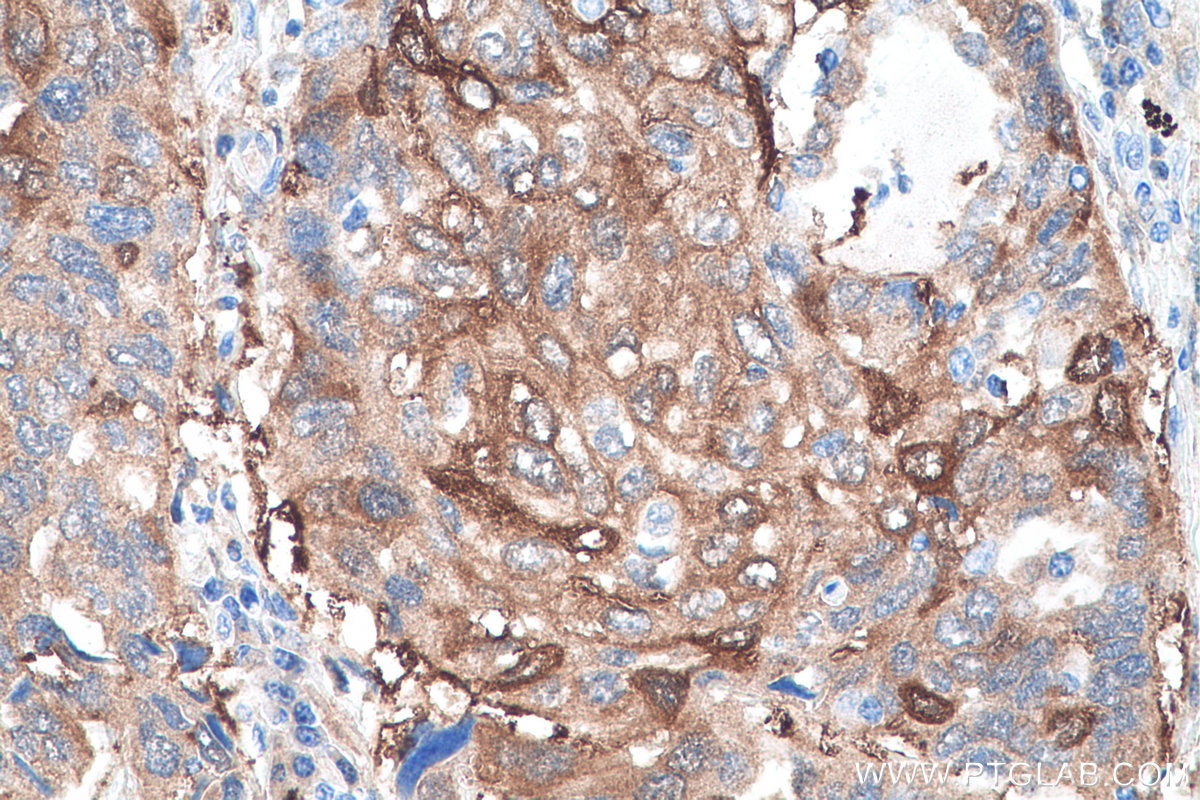 Immunohistochemistry (IHC) staining of human lung cancer tissue using GSTM3 Monoclonal antibody (67634-1-Ig)