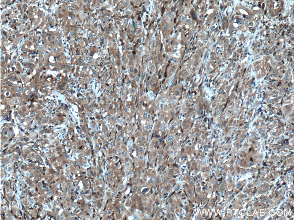 IHC staining of human cervical cancer using 16766-1-AP