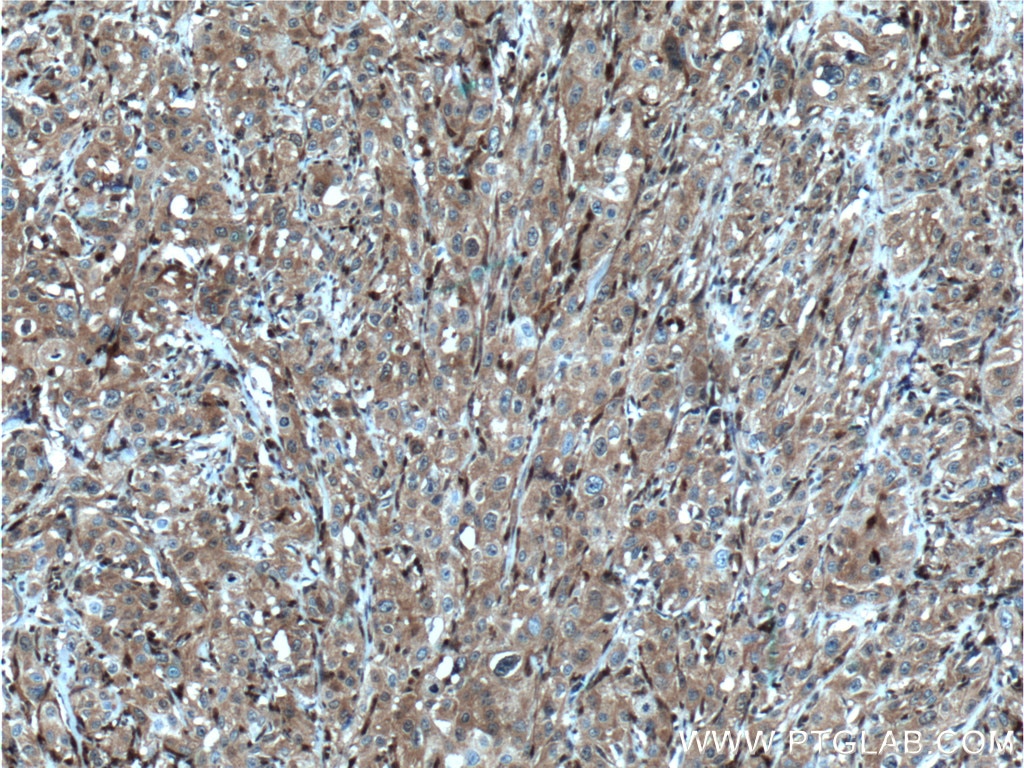 Immunohistochemistry (IHC) staining of human cervical cancer tissue using GSTM4 Polyclonal antibody (16766-1-AP)