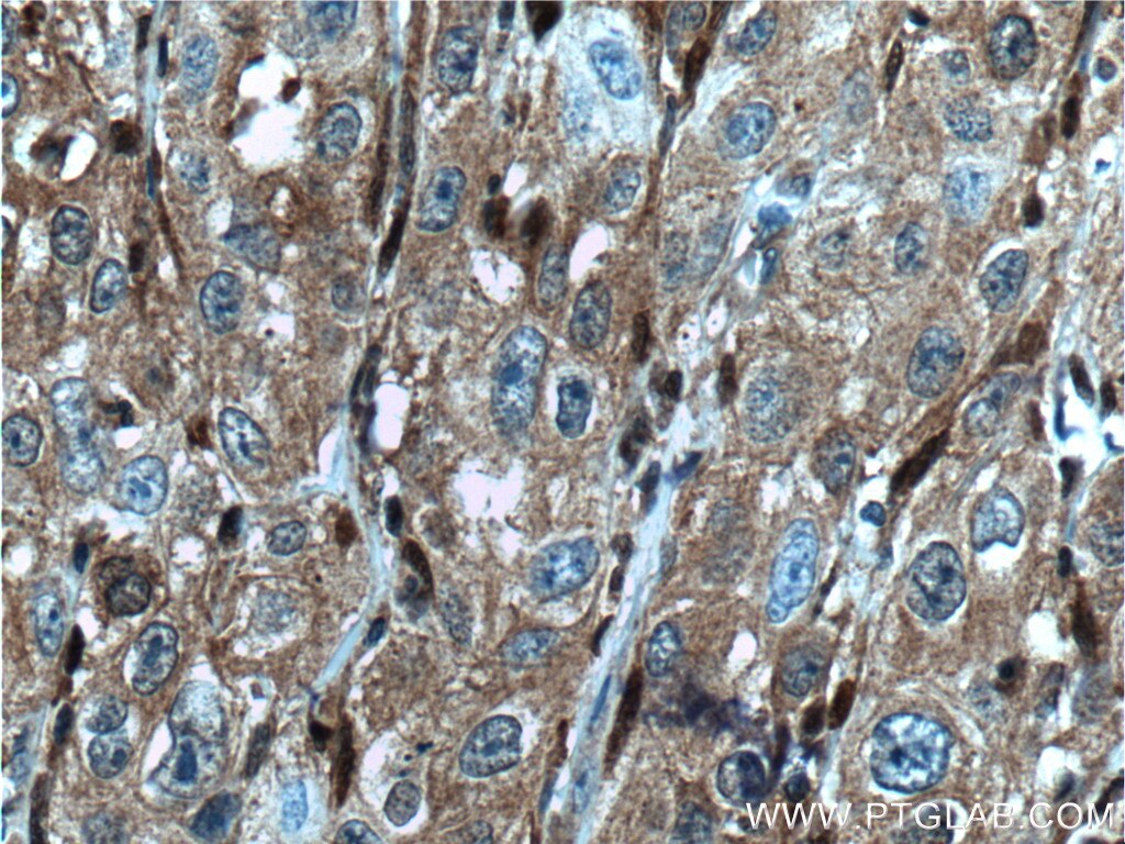 Immunohistochemistry (IHC) staining of human cervical cancer tissue using GSTM4 Polyclonal antibody (16766-1-AP)