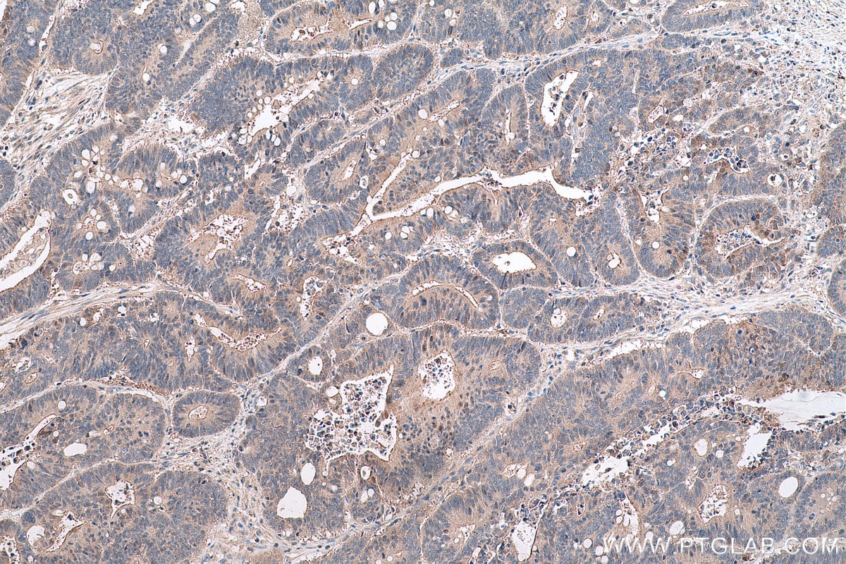 Immunohistochemistry (IHC) staining of human colon cancer tissue using GSTM4 Polyclonal antibody (16766-1-AP)