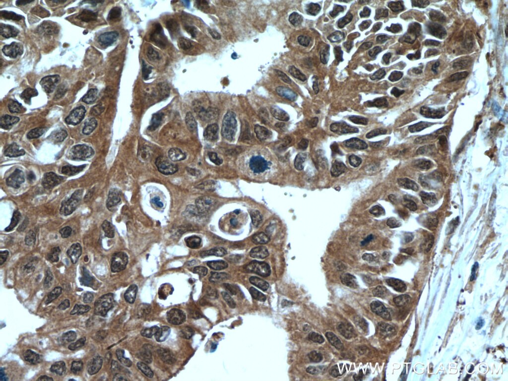 IHC staining of human pancreas cancer using 15124-1-AP