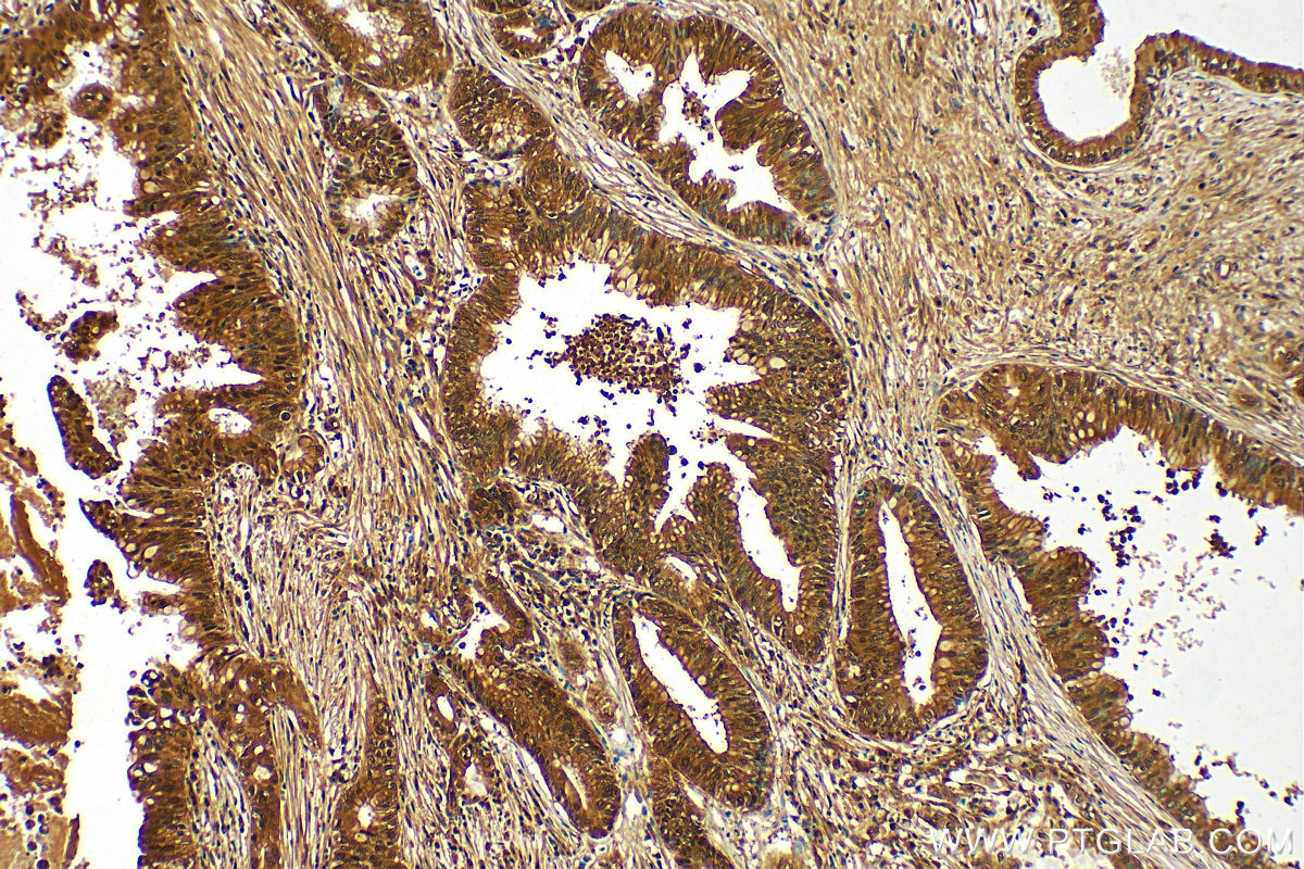 Immunohistochemistry (IHC) staining of human pancreas cancer tissue using GSTO1 Polyclonal antibody (15124-1-AP)