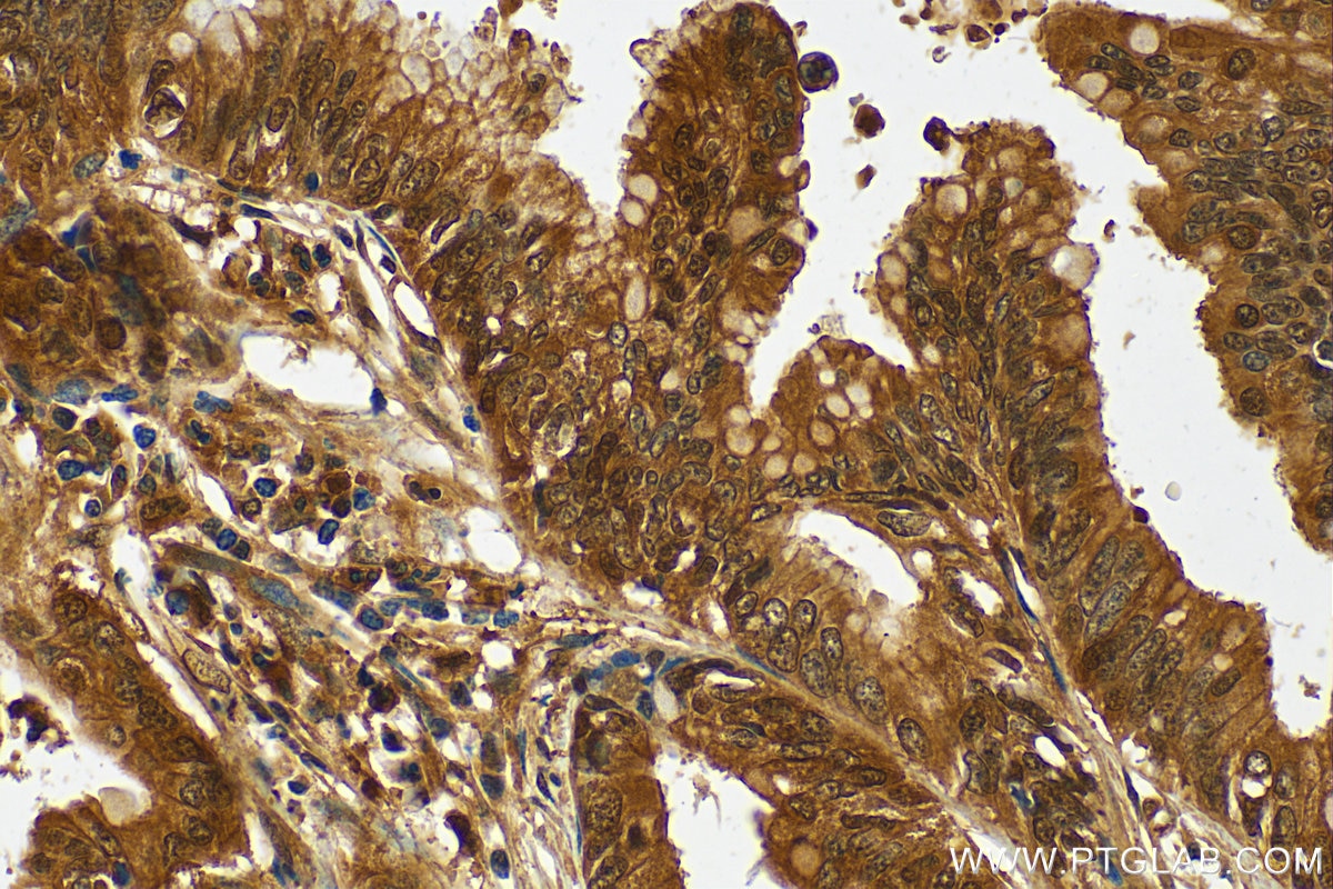 Immunohistochemistry (IHC) staining of human pancreas cancer tissue using GSTO1 Polyclonal antibody (15124-1-AP)