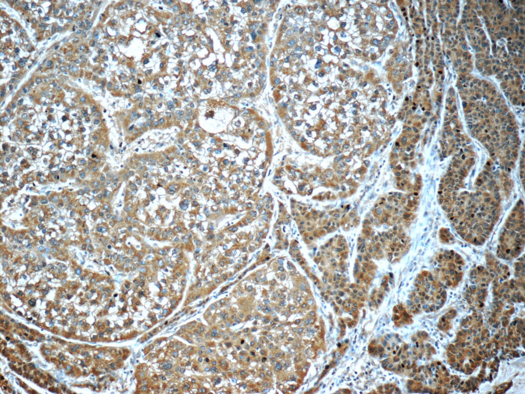 Immunohistochemistry (IHC) staining of human liver cancer tissue using GSTO1 Monoclonal antibody (60150-2-Ig)