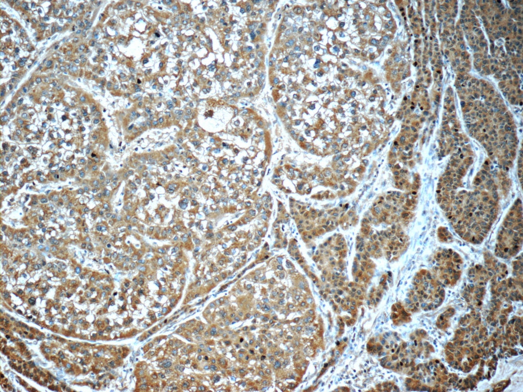 IHC staining of human liver cancer using 60150-2-Ig