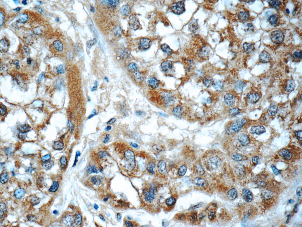 IHC staining of human liver cancer using 60150-2-Ig
