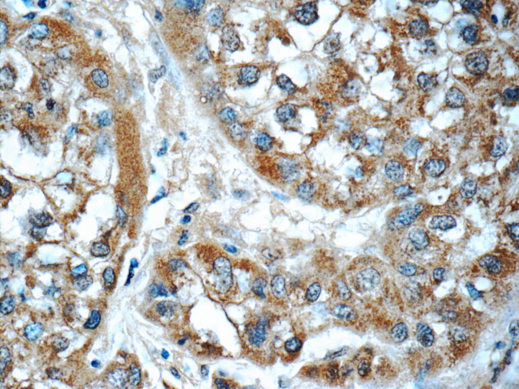 Immunohistochemistry (IHC) staining of human liver cancer tissue using GSTO1 Monoclonal antibody (60150-2-Ig)