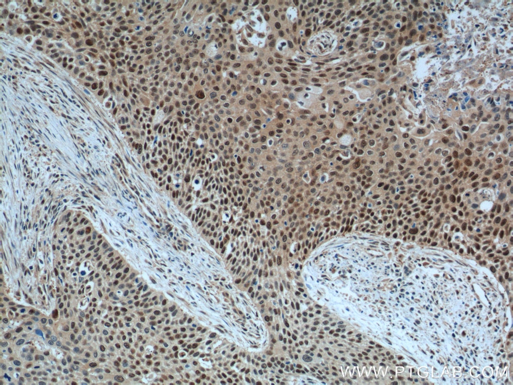 Immunohistochemistry (IHC) staining of human oesophagus cancer tissue using GSTO1 Monoclonal antibody (60150-2-Ig)