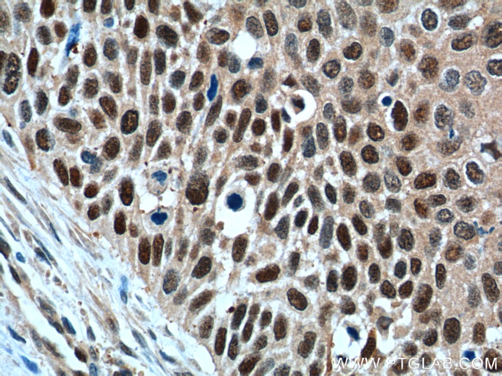 Immunohistochemistry (IHC) staining of human oesophagus cancer tissue using GSTO1 Monoclonal antibody (60150-2-Ig)