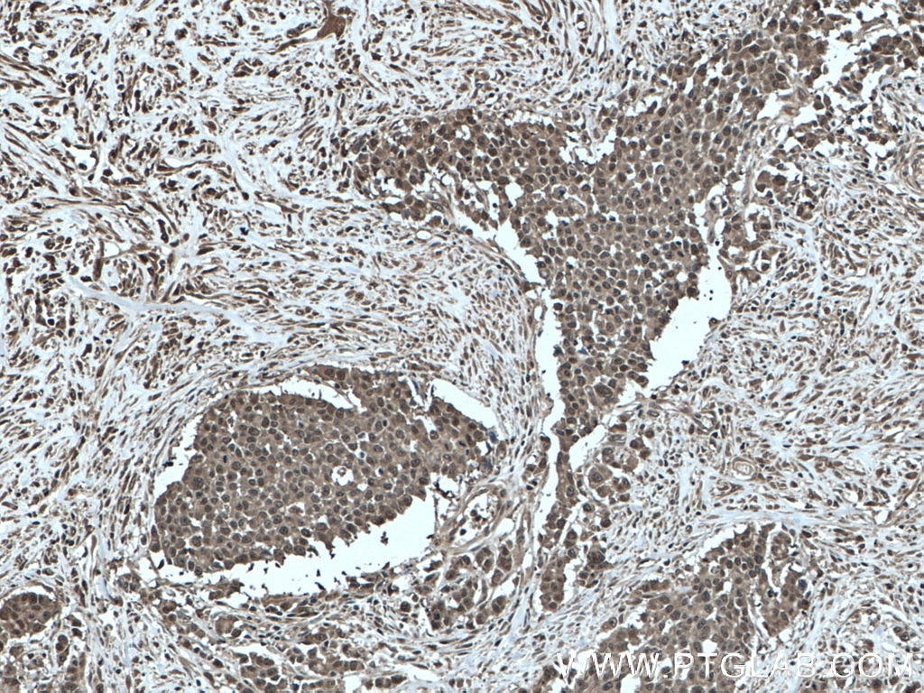 Immunohistochemistry (IHC) staining of human colon cancer tissue using GSTP1 Monoclonal antibody (66715-1-Ig)