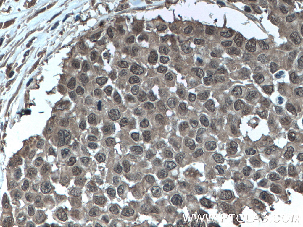 Immunohistochemistry (IHC) staining of human colon cancer tissue using GSTP1 Monoclonal antibody (66715-1-Ig)