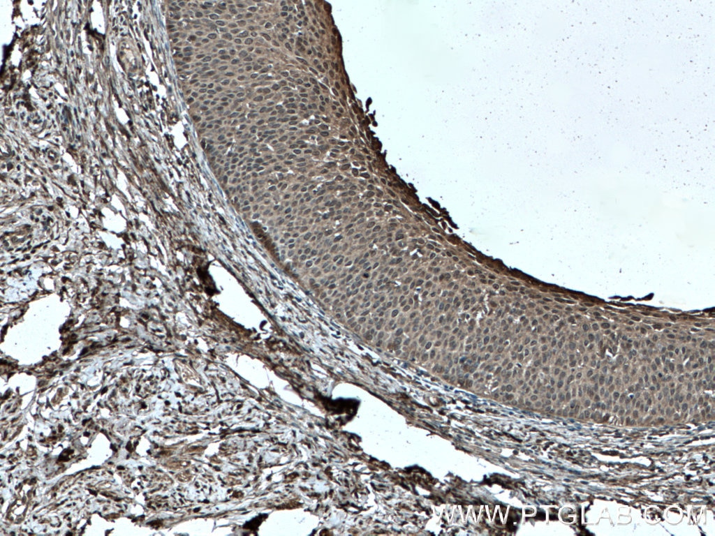 Immunohistochemistry (IHC) staining of human cervical cancer tissue using GSTP1 Monoclonal antibody (66715-1-Ig)