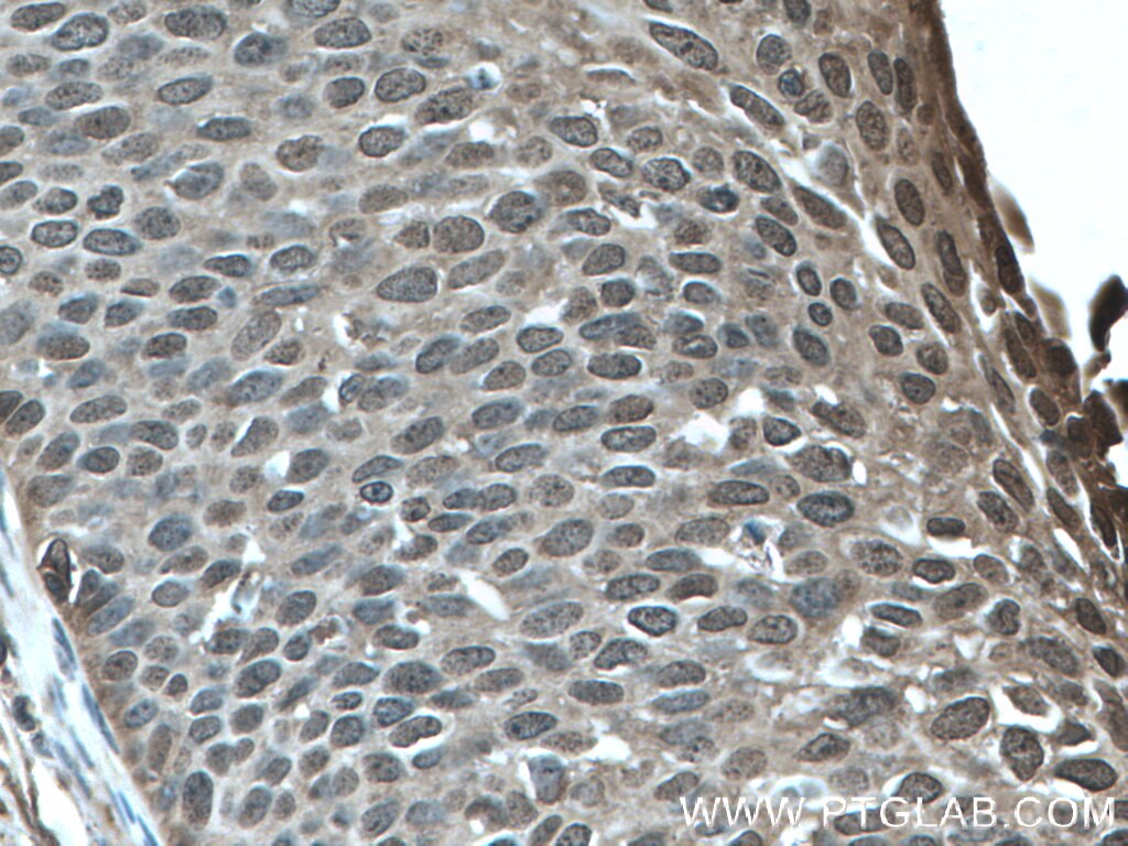 Immunohistochemistry (IHC) staining of human cervical cancer tissue using GSTP1 Monoclonal antibody (66715-1-Ig)
