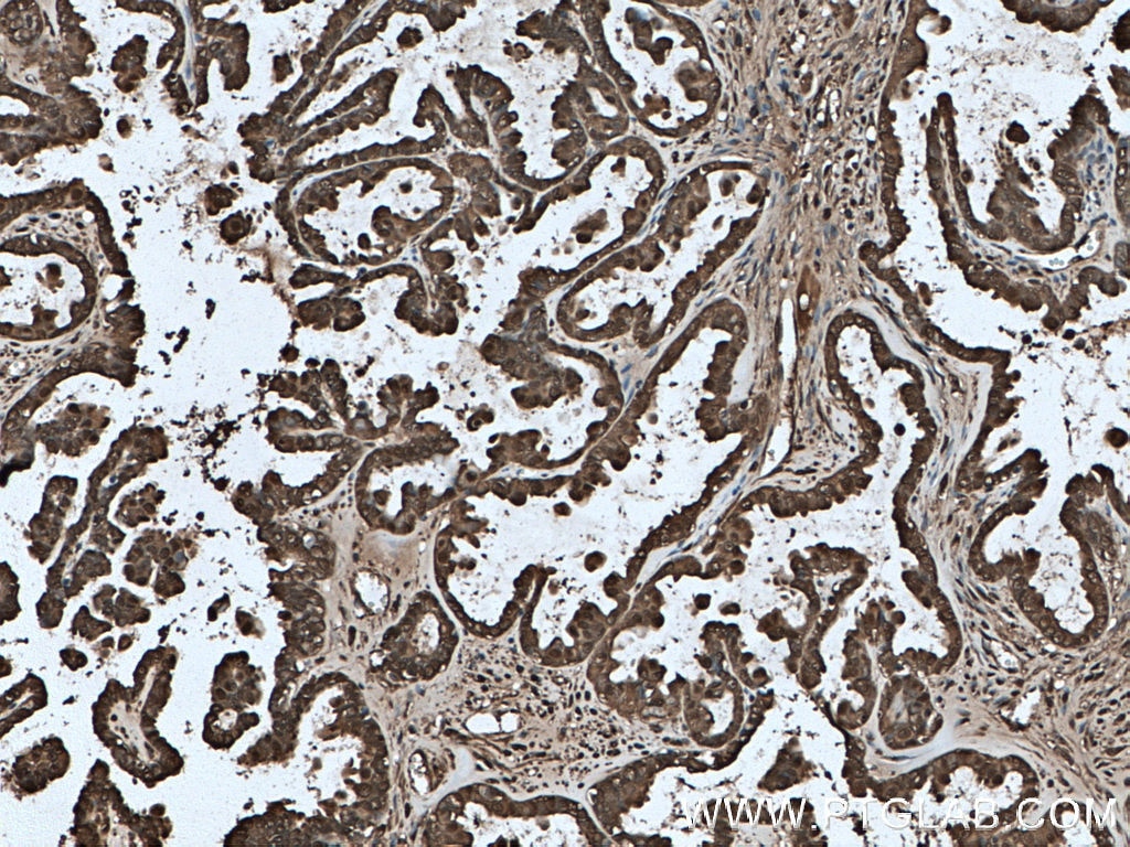 Immunohistochemistry (IHC) staining of human ovary tumor tissue using GSTP1 Monoclonal antibody (66715-1-Ig)