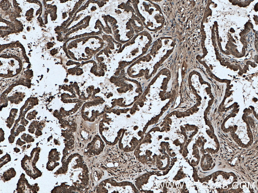 IHC staining of human ovary tumor using 66715-1-Ig