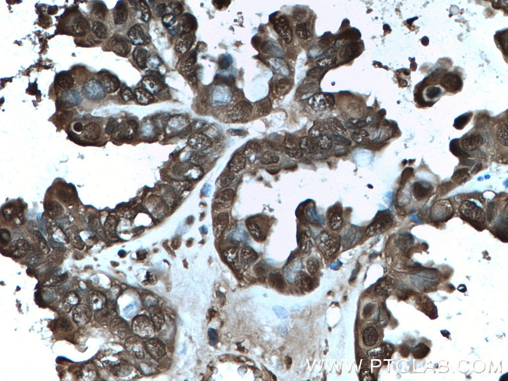 Immunohistochemistry (IHC) staining of human ovary tumor tissue using GSTP1 Monoclonal antibody (66715-1-Ig)