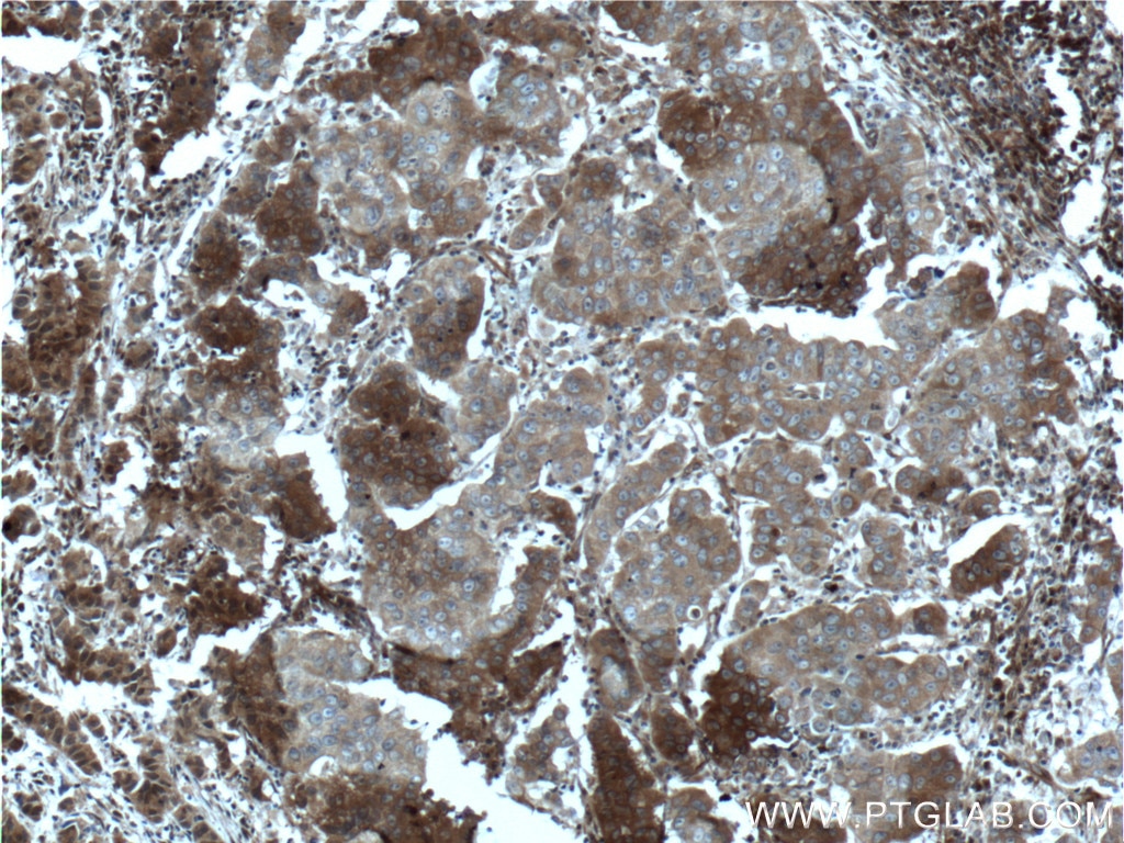 Immunohistochemistry (IHC) staining of human prostate cancer tissue using GSTT2 Polyclonal antibody (15063-1-AP)