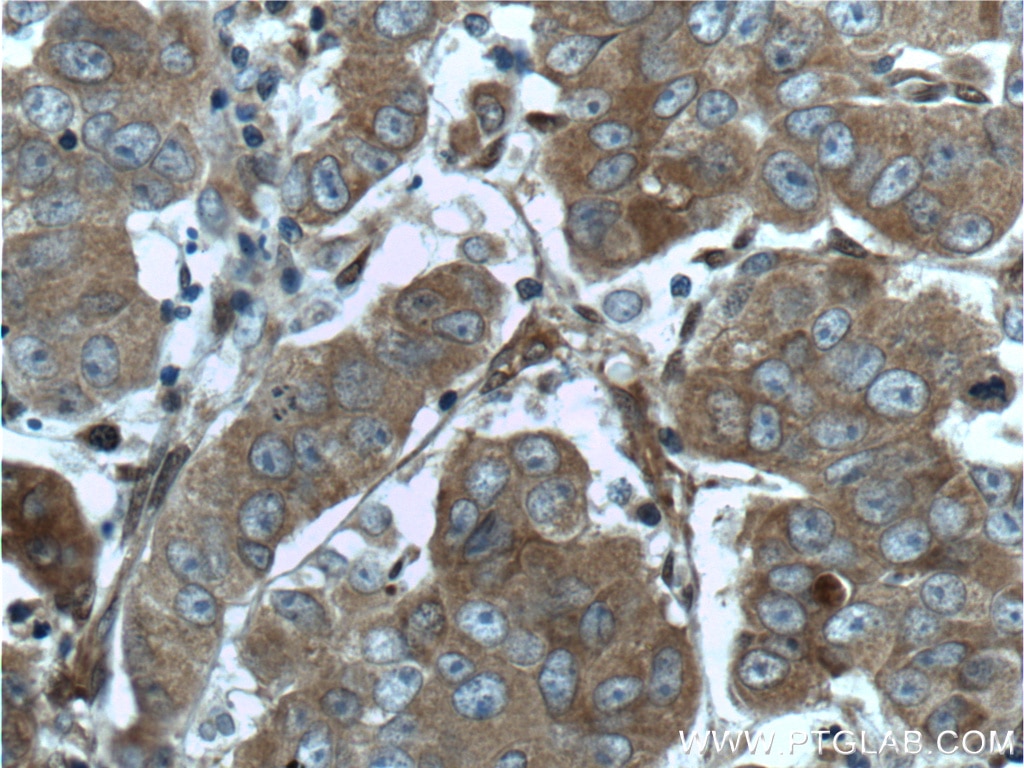 Immunohistochemistry (IHC) staining of human prostate cancer tissue using GSTT2 Polyclonal antibody (15063-1-AP)