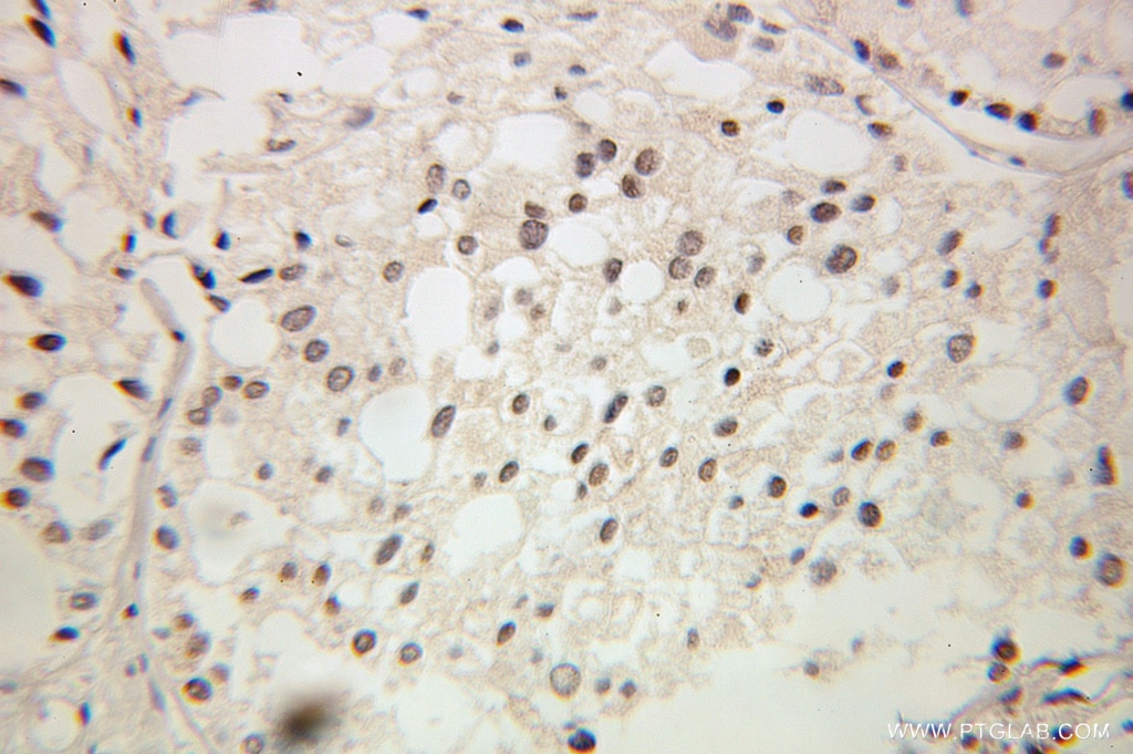 Immunohistochemistry (IHC) staining of human prostate cancer tissue using GTF2A2 Polyclonal antibody (10540-1-AP)