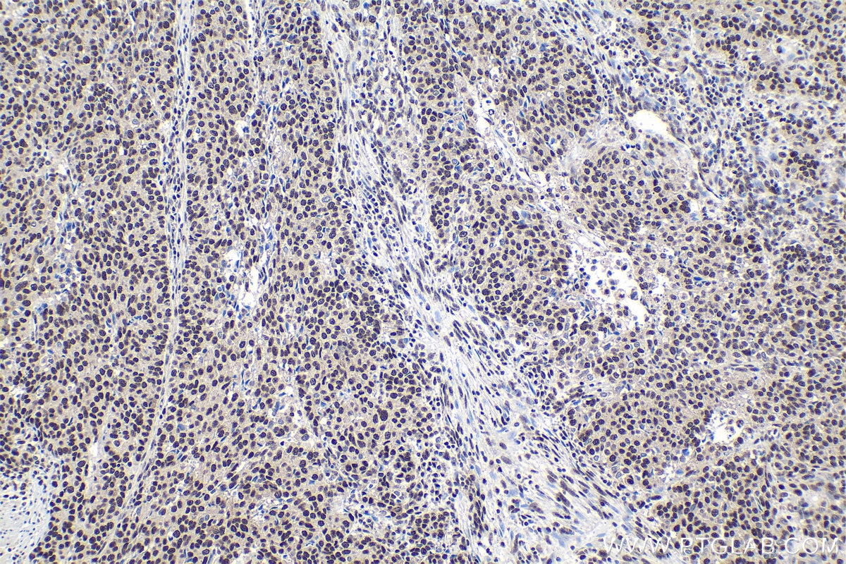 Immunohistochemistry (IHC) staining of human stomach cancer tissue using GTF2E1 Polyclonal antibody (24405-1-AP)