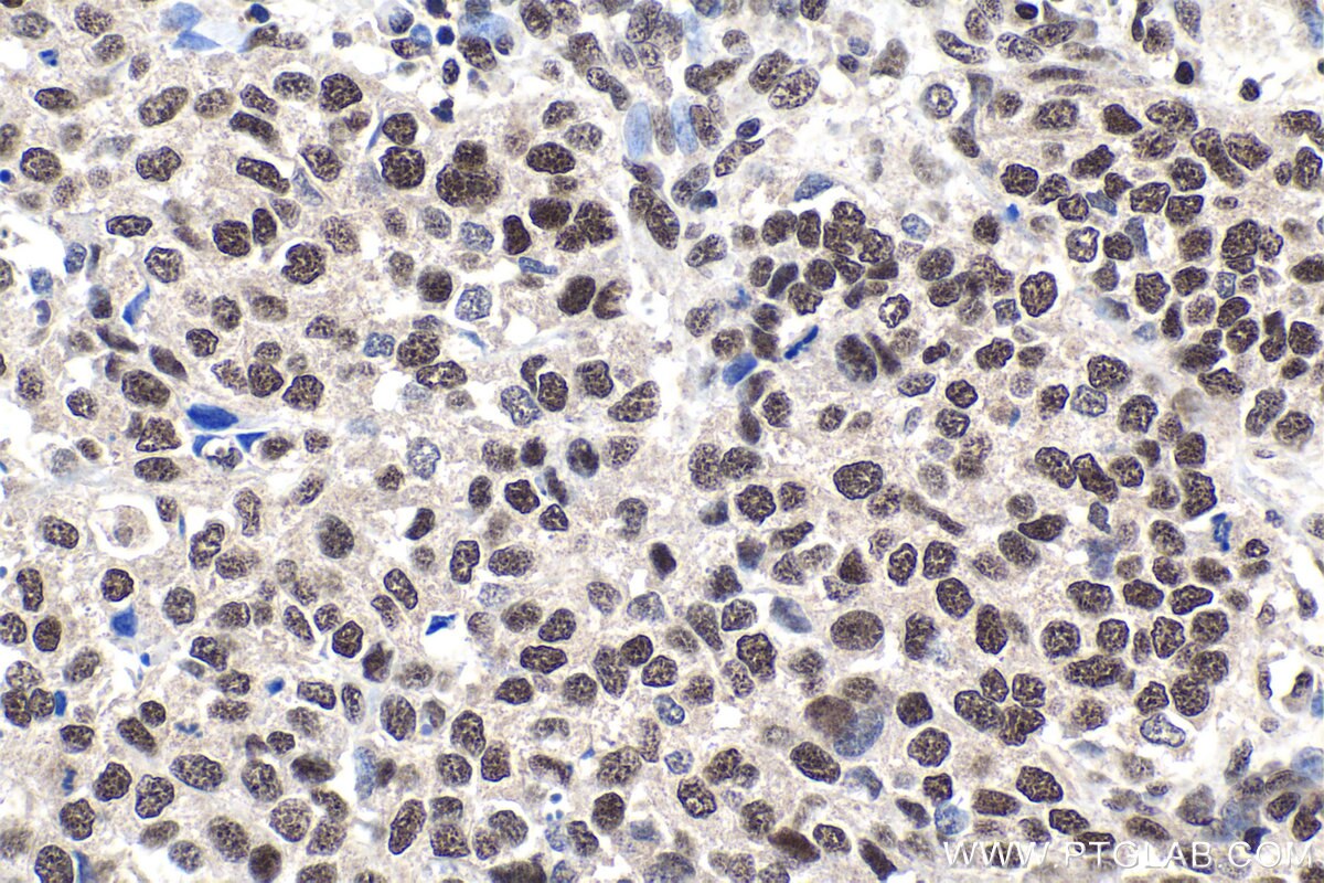 Immunohistochemistry (IHC) staining of human stomach cancer tissue using GTF2E1 Polyclonal antibody (24405-1-AP)