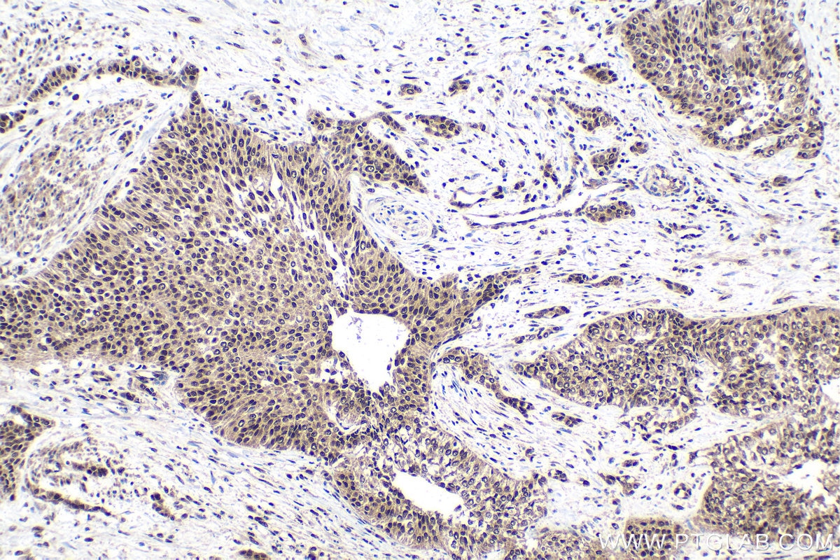 Immunohistochemistry (IHC) staining of human urothelial carcinoma tissue using GTF2E1 Polyclonal antibody (24405-1-AP)