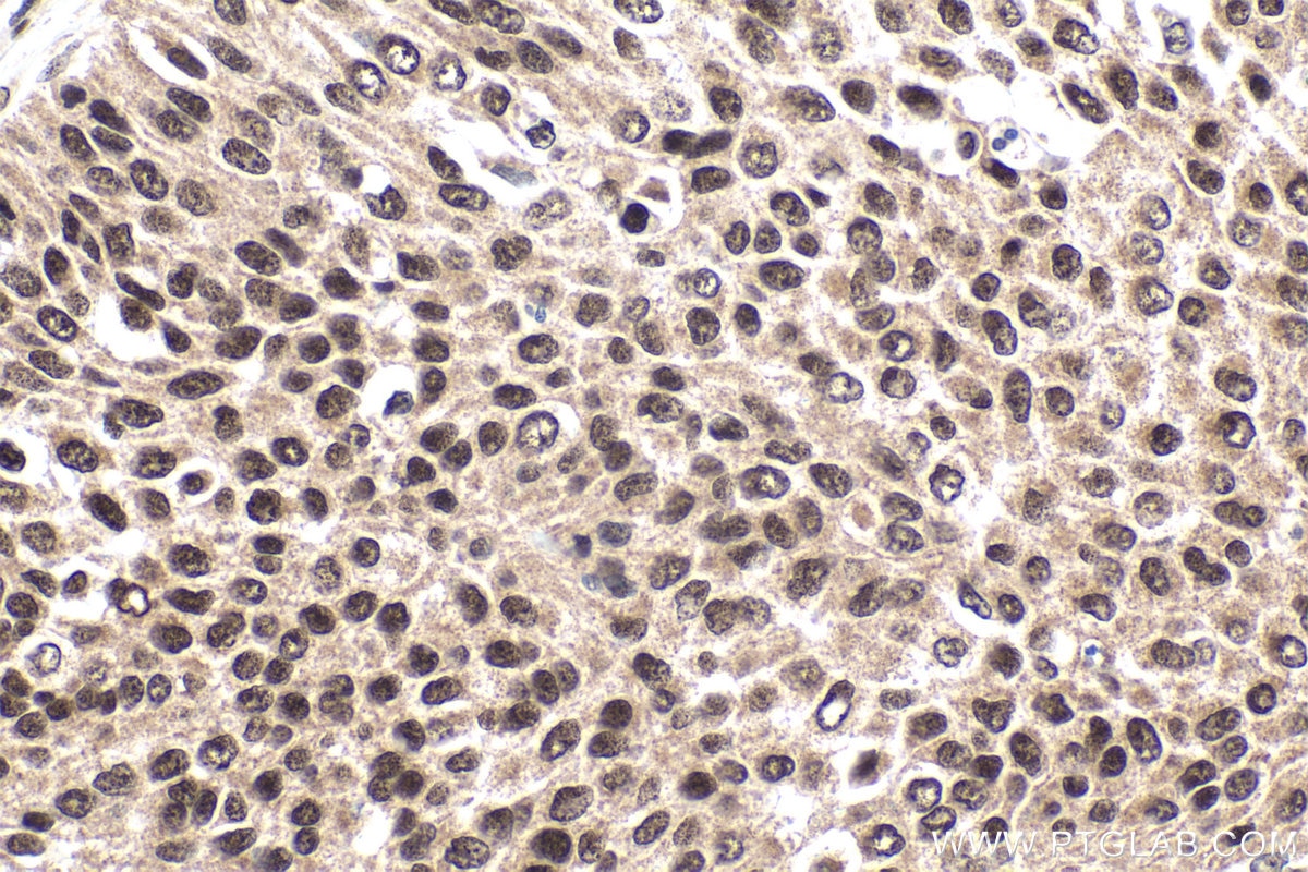 Immunohistochemistry (IHC) staining of human urothelial carcinoma tissue using GTF2E1 Polyclonal antibody (24405-1-AP)