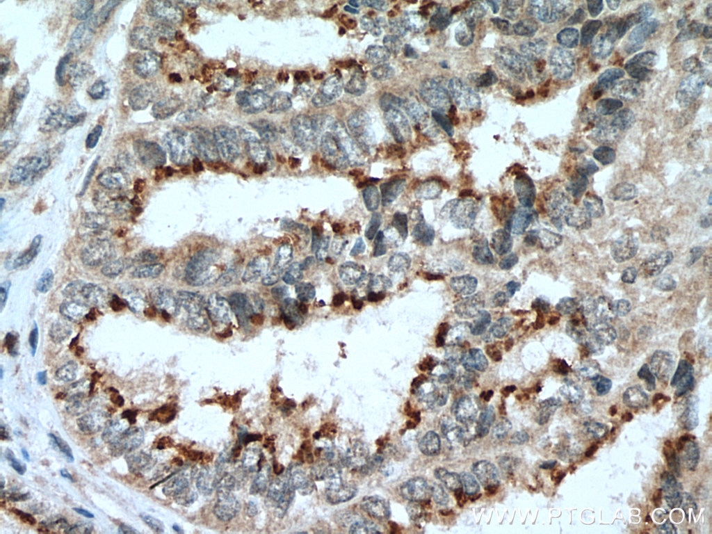 IHC staining of human ovary tumor using 29112-1-AP Immunohistochemistry (IHC) staining of human ovary tumor tissue using GTF2H5 Polyclonal antibody (29112-1-AP)