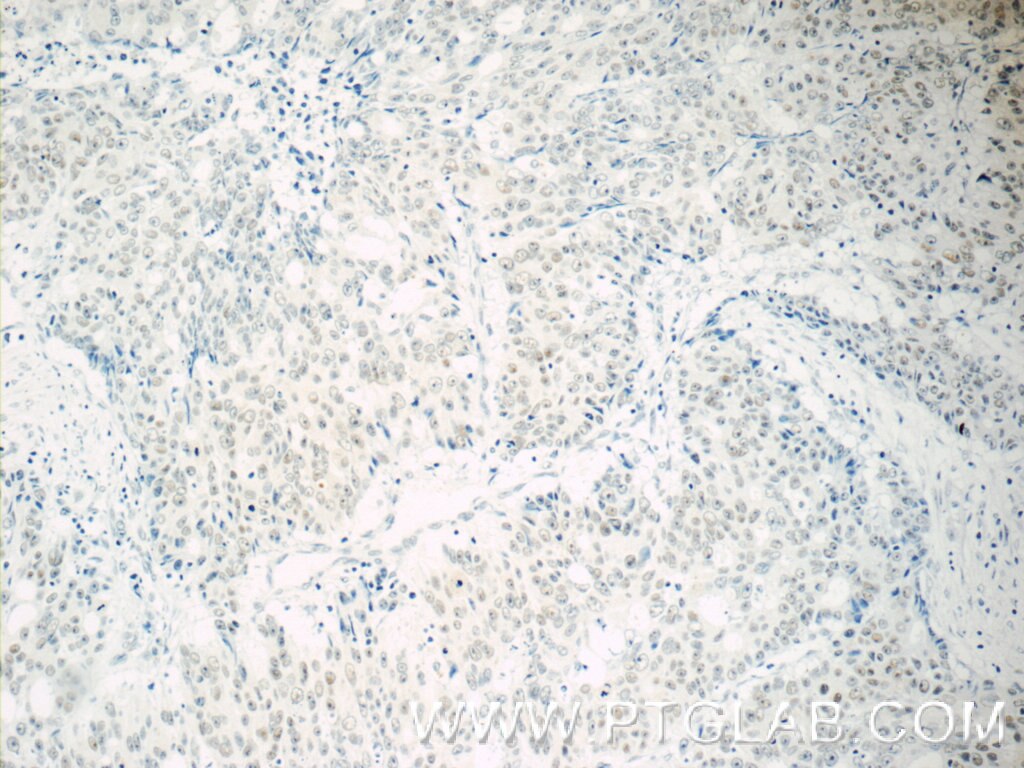 Immunohistochemistry (IHC) staining of human colon cancer tissue using TFII I Polyclonal antibody (10499-1-AP)