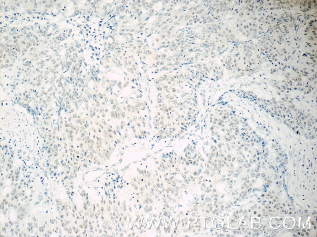 Immunohistochemistry (IHC) staining of human colon cancer tissue using TFII I Polyclonal antibody (10499-1-AP)