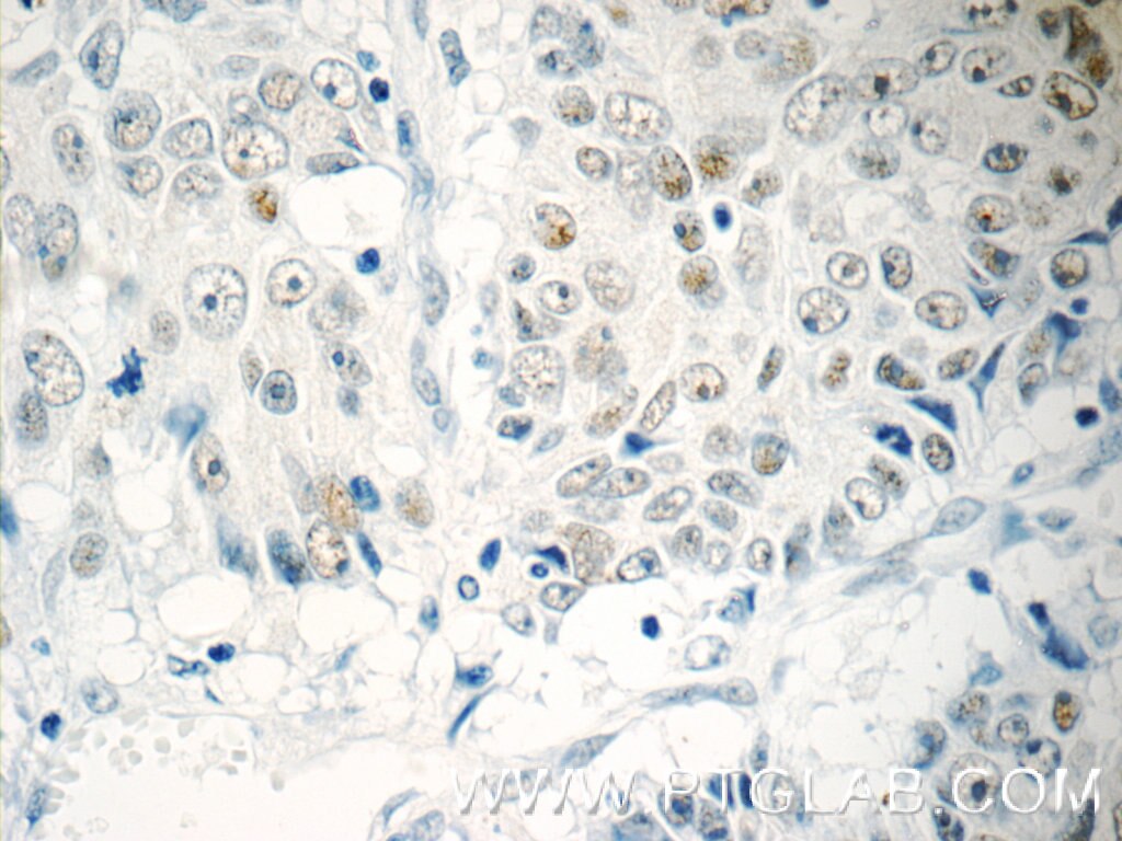Immunohistochemistry (IHC) staining of human colon cancer tissue using TFII I Polyclonal antibody (10499-1-AP)