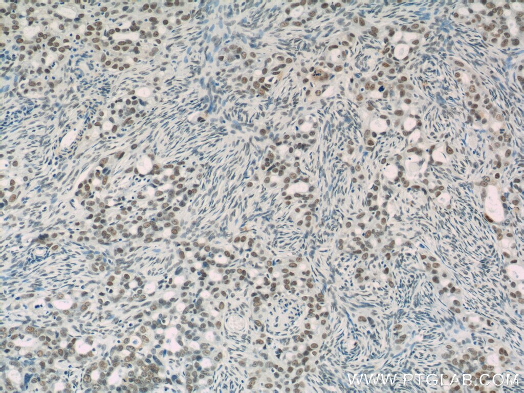 Immunohistochemistry (IHC) staining of human ovary tumor tissue using TFII I Polyclonal antibody (10499-1-AP)