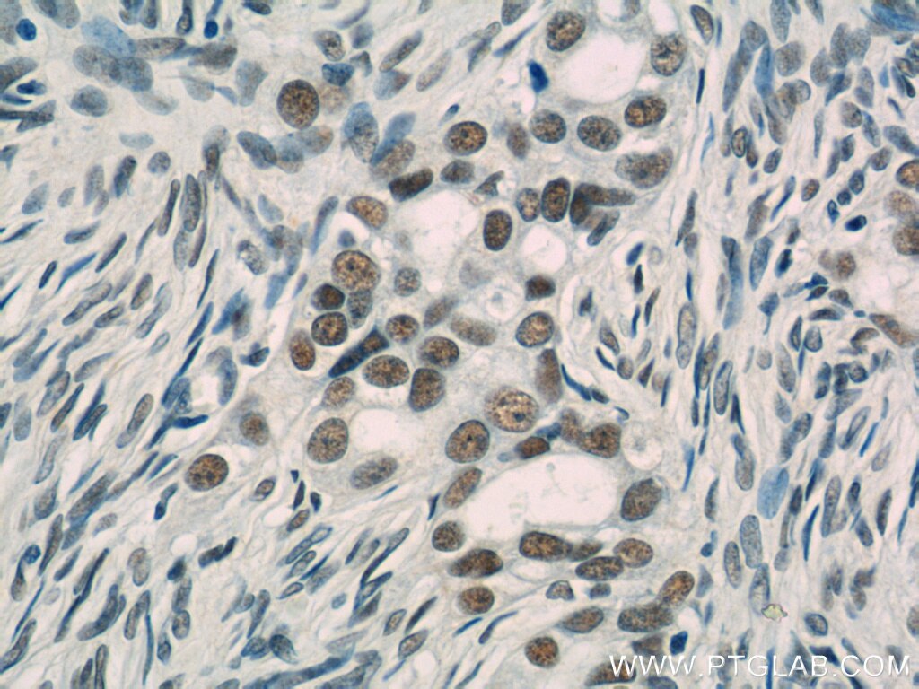 Immunohistochemistry (IHC) staining of human ovary tumor tissue using TFII I Polyclonal antibody (10499-1-AP)