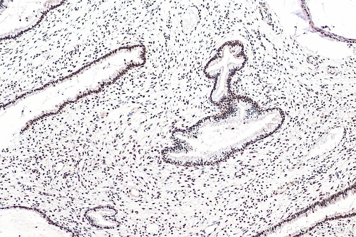 Immunohistochemistry (IHC) staining of human cervical cancer tissue using GTF3C2 Polyclonal antibody (27494-1-AP)