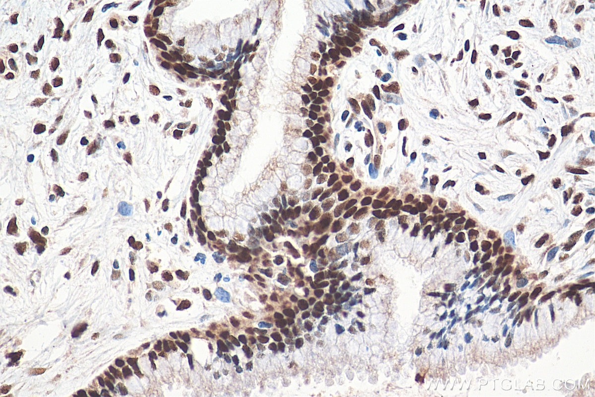 Immunohistochemistry (IHC) staining of human cervical cancer tissue using GTF3C2 Polyclonal antibody (27494-1-AP)