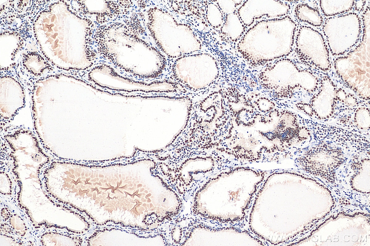 Immunohistochemistry (IHC) staining of human thyroid cancer tissue using GTF3C2 Polyclonal antibody (27494-1-AP)