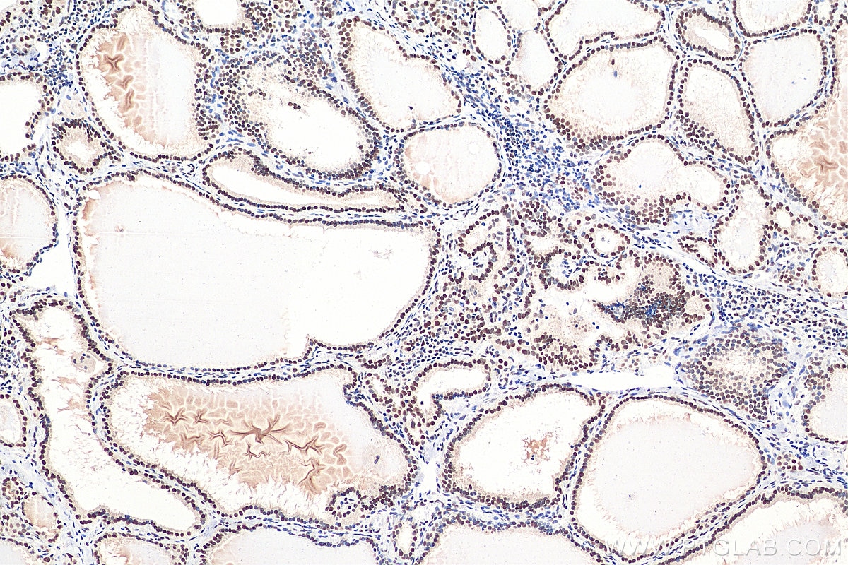 IHC staining of human thyroid cancer using 27494-1-AP