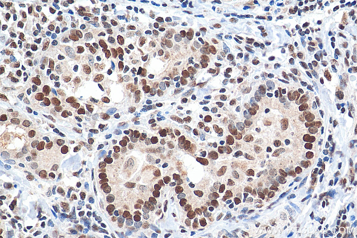 Immunohistochemistry (IHC) staining of human thyroid cancer tissue using GTF3C2 Polyclonal antibody (27494-1-AP)