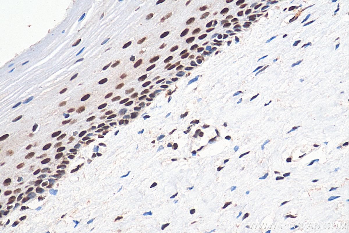 Immunohistochemistry (IHC) staining of human cervical cancer tissue using GTF3C2 Polyclonal antibody (27494-1-AP)